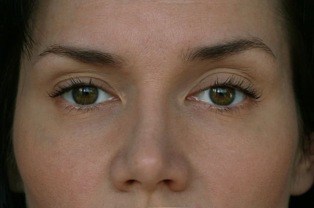 Eye Ptosis Repair for St. Petersburg & Clearwater, FL