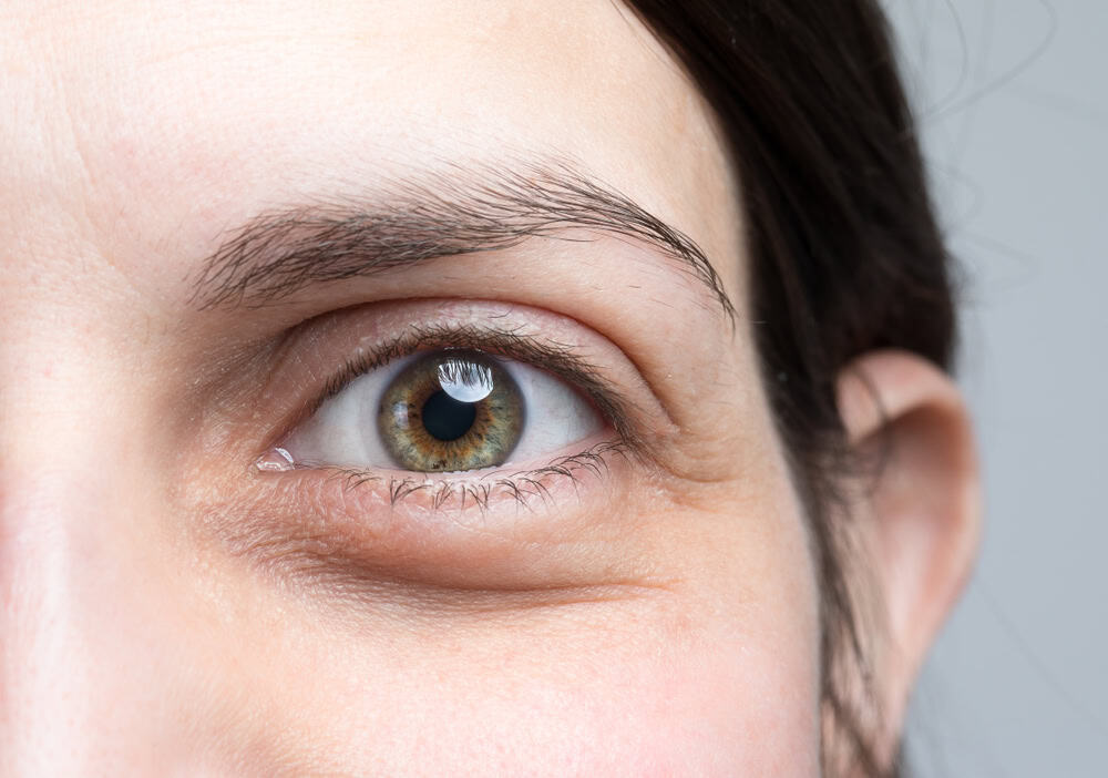 Eyelid Surgery for St. Petersburg & Clearwater, FL