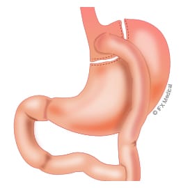 Roux-en-Y Gastric Bypass Surgery