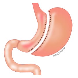 Sleeve Gastrectomy