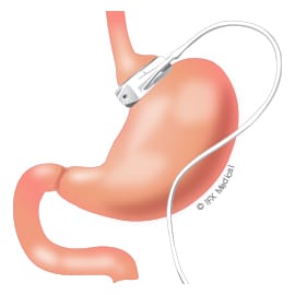 Gastric Band