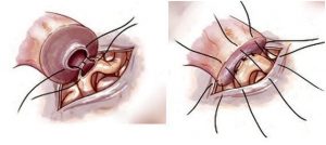 End-To-Side Epididymovasostomy