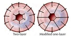 Vasovasostomy Techniques