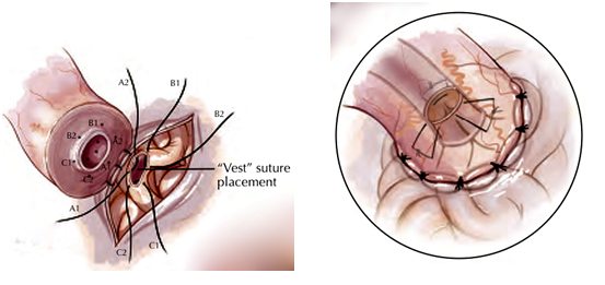 Invagination Epididymovasostomy