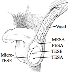 Surgical Sperm Retrieval for IUI