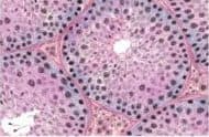 Testicular Biopsy Azoospermia
