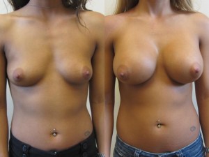Breast Augmentation in Tampa