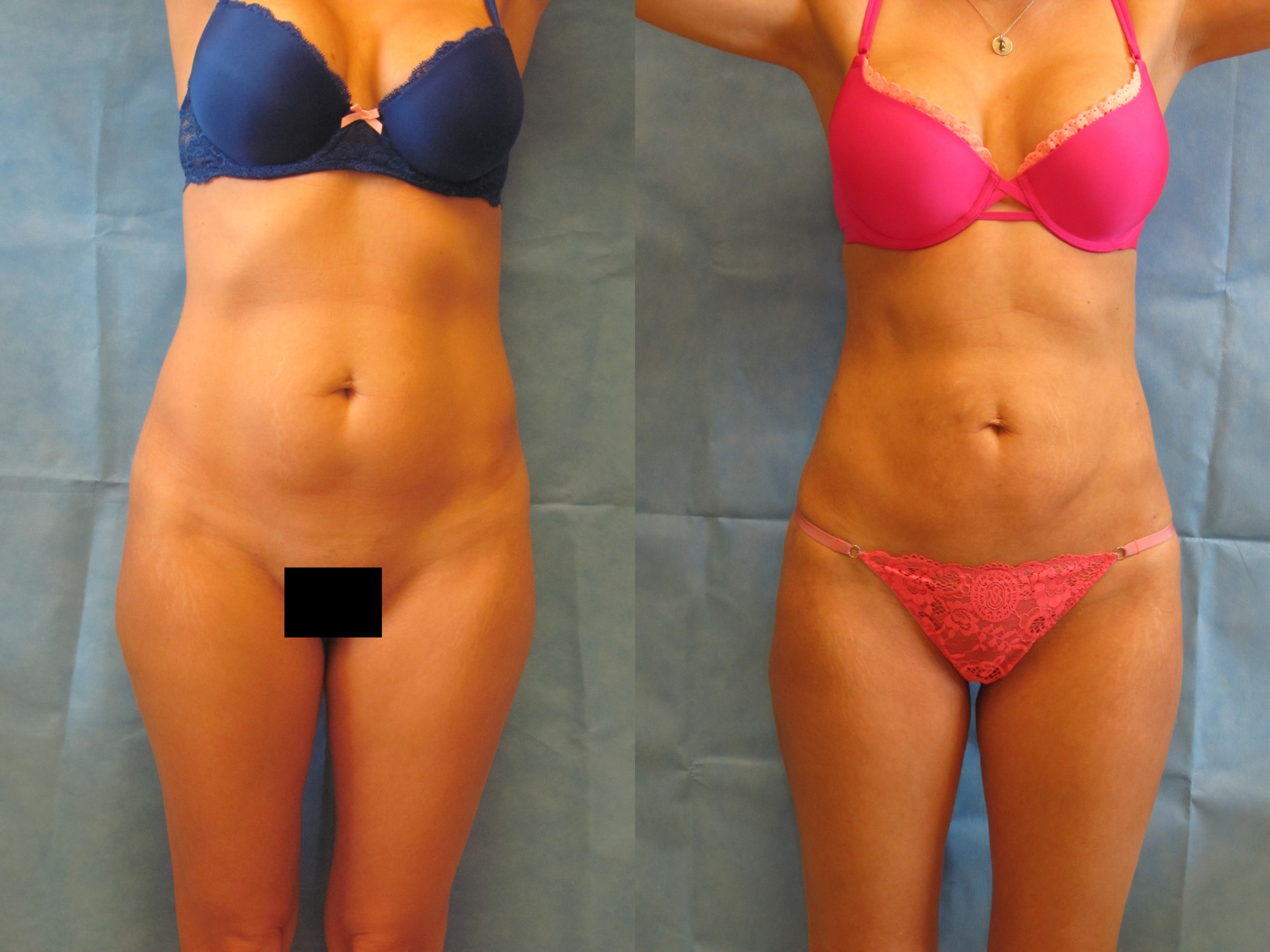 How Much Does Lipo 360 Cost? - Exert Clinic