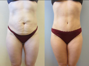 Tampa Tummy Tuck Patients Photo Gallery