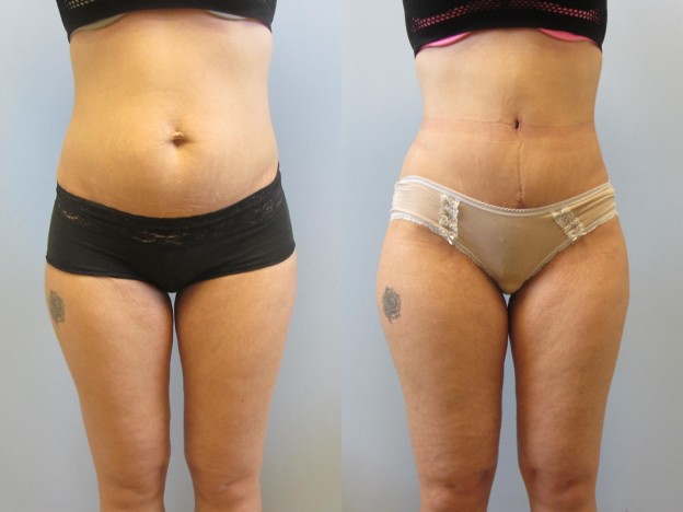 Tummy Tuck Recovery - NuBody Concepts
