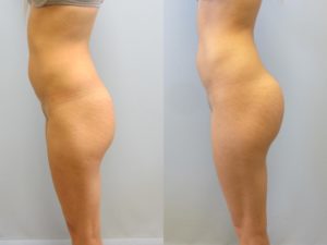 gluteal implants butt implants tampa FL