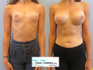 Cosmetic Procedures Tampa - Breast Augmentation Before & After