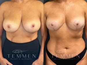 Breast Surgery Before and After Photos Tampa, FL - Dr Temmen