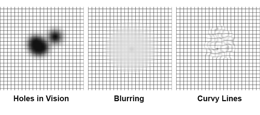 Macular Degeneration Test Grid Amsler Grid Brevard Eye