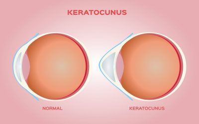 The Dangers of Ignoring Keratoconus