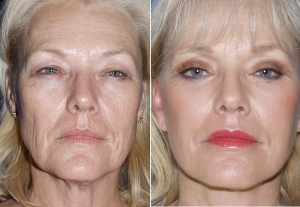 facelift san diego