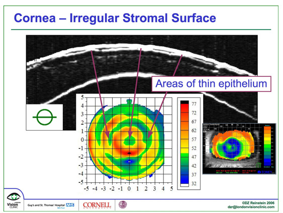 Cornea - Irregular Stromal Surface