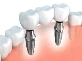 Implant-Supported Dental Implants