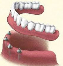 All on 4 Dental Implants