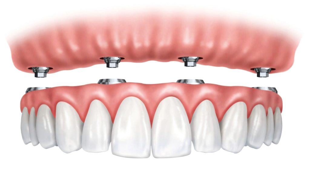 Dental Implants in Countryside, IL